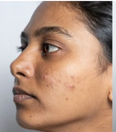Before - Meera, 25