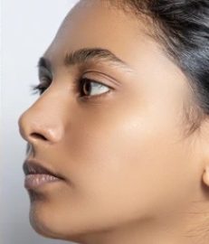 After - Meera, 25